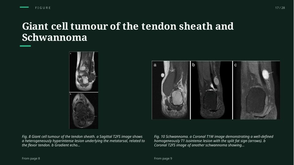 MRI of Soft Tissue Tumors of the Foot and Ankle: Clinical figure with its context
