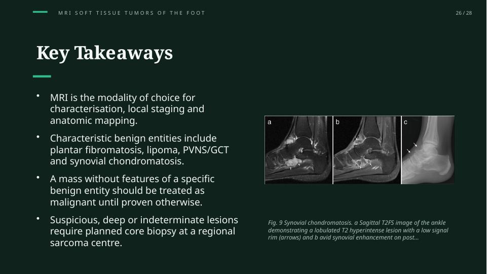 MRI of Soft Tissue Tumors of the Foot and Ankle: Visual takeaways